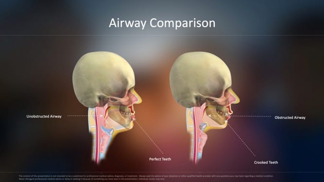 airway comparison image