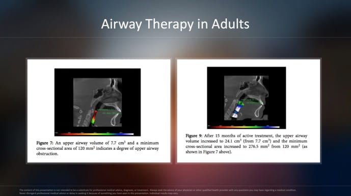 airway therapy results in adults 