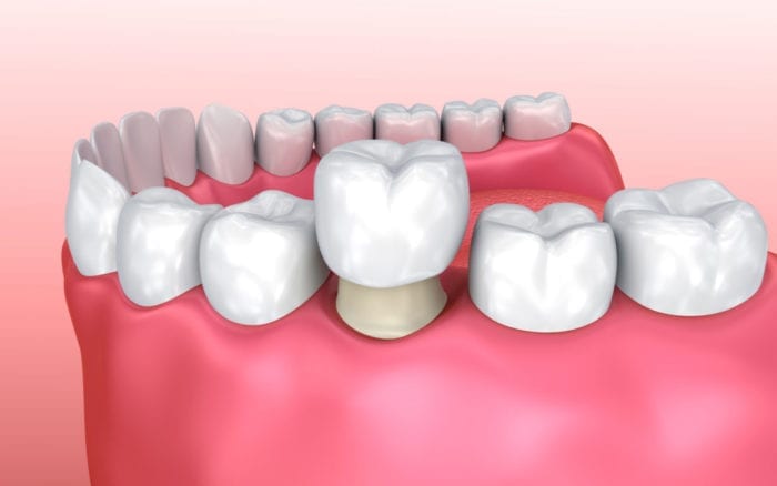 Dental Crown in Acton, MA for damaged teeth